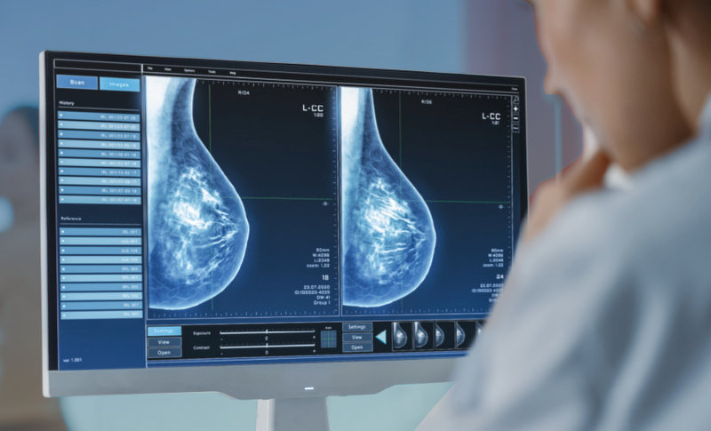 Atualmente cobertura é apenas para mulheres de 40 a 69 anos de idade